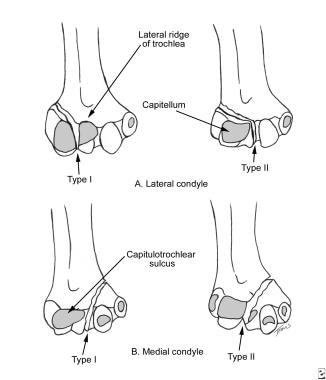 Milch classification of condylar fractures. 