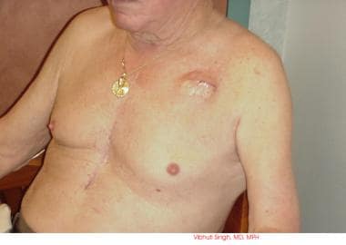 Patient showing pacemaker swelling under the left 