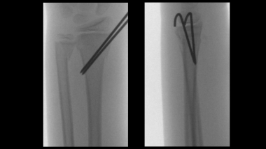 Growth plate (physeal) fractures. Closed reduction