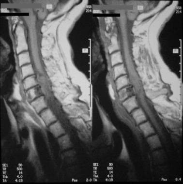 Spinal meningioma with intradural, extramedullary,