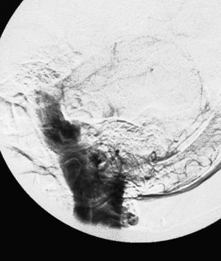 A late angiogram demonstrating contrast medium fil