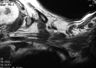 Brachial plexus injury. Non-Hodgkin lymphoma. Axia