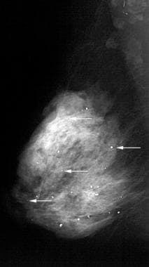 Scattered round and punctate calcifications (arrow