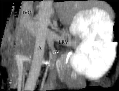 Coronal CT angiogram (CTA) in a potential renal do