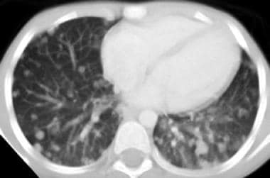 CT of the chest demonstrates diffuse bilateral pul