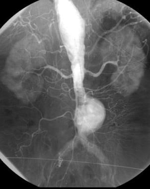 Arteriogram demonstrates an infrarenal abdominal a