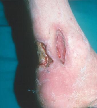 Significant posterior ankle defect with exposed Ac