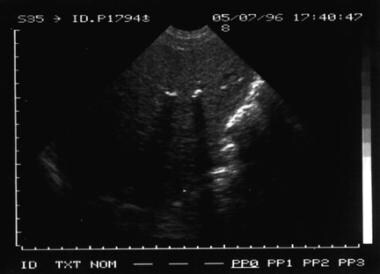 Sonogram of an abortive form of alveolar echinococ