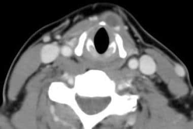 Axial CT scan of a patient with a relatively small