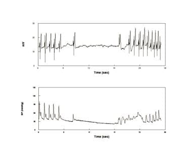 An asystolic faint. Electrocardiogram (upper panel