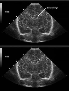 Grade I hemorrhage minimal or grade I periventricu