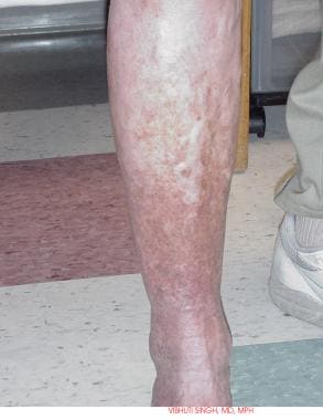 Varicose veins and venous stasis with skin discolo