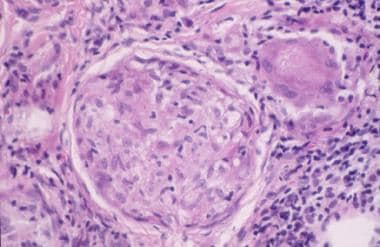 Histopathologic features of sarcoidosis showing th