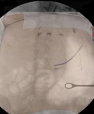 Abdominal photograph is superimposed on abdominal