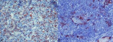 Pathology of Embryonal Tumors. (A): Vimentin posit
