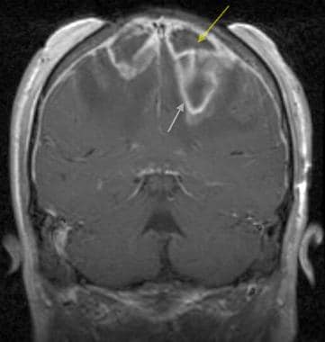 Brain abscess. Coronal T1-weighted post–gadolinium