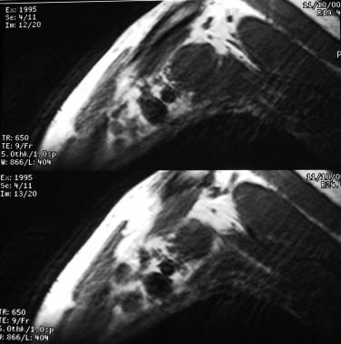 Brachial plexus injury. Non-Hodgkin lymphoma in a 