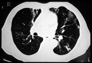 Cystic fibrosis, thoracic. CT image shows a peribr