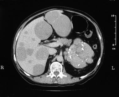 Appearance of pancreatic carcinoid. Nonenhanced CT