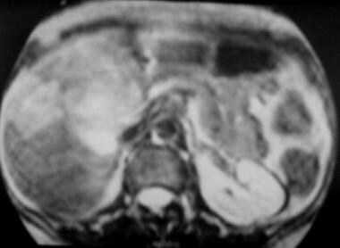T2-weighted magnetic resonance image (same patient