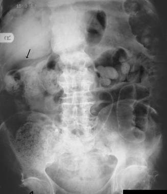 Pneumoperitoneum. Supine abdominal radiograph show
