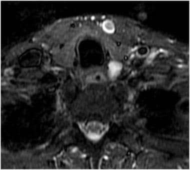 Axial STIR image showing a T2 hyperintense lesion 