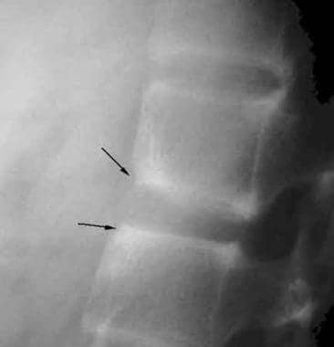 Lateral radiograph shows anterior corner erosions 