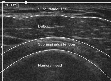 Shoulder, rotator cuff injury (ultrasonography). D