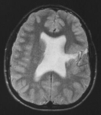 Schizencephaly. Axial T2-weighted MRI demonstrates