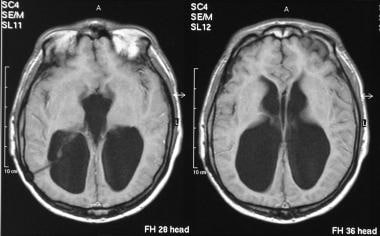 Axial T1-weighted MRIs of the brain show gross ven