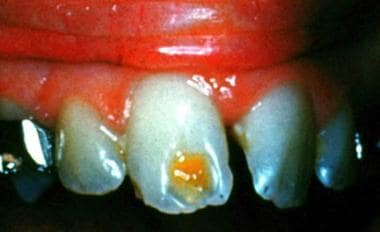 Severe enamel hypoplasia (ie, Turner tooth) on a s