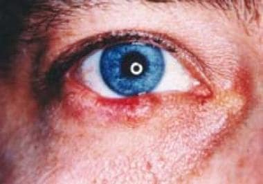 A 63-year-old white man with lower eyelid sebaceou