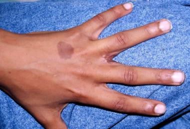 Simple incomplete syndactyly between long finger a