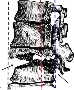 Drawing of Chance fracture of thoracolumbar juncti