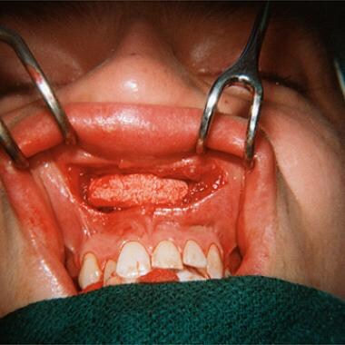 Proplast nasal grafts. A 20-year-old man with a po