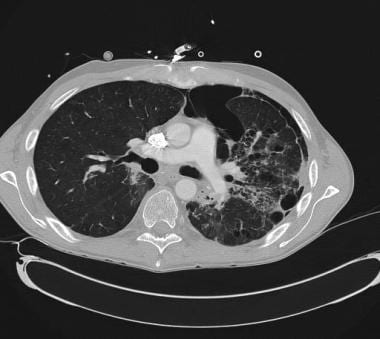 CT scan demonstrating secondary spontaneous pneumo