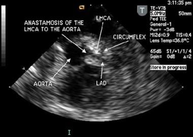 This is an intraoperative transesophageal, transve