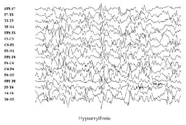 Electroencephalogram demonstrating hypsarrhythmia 
