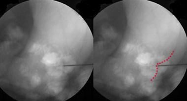 With anterior fluoroscopy alone, depth of needle c