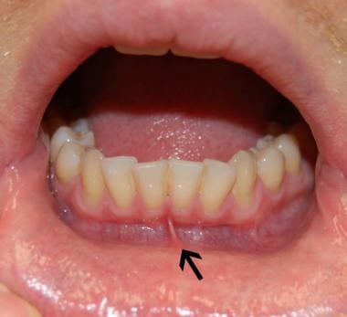 What is a white bump on the inside of your lower lip?