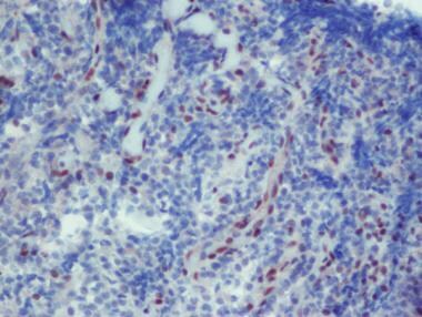Loss of INI1 protein nuclear expression is a diagn