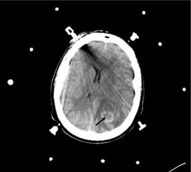 Brain abscess. Axial CT scan obtained with intrave