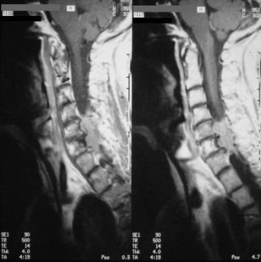 Sagittal contrast-enhanced T1-weighted MRIs show a
