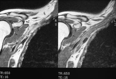 Brachial plexus injury. Neurofibromatosis type 1 i