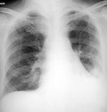 Aspiration pneumonia. An 84-year-old man in genera