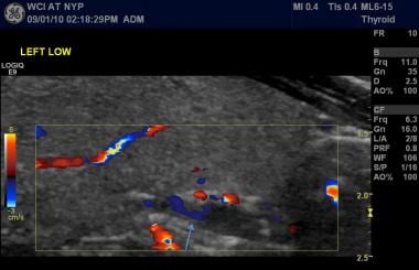 Ultrasound imaging with color Doppler interrogatio