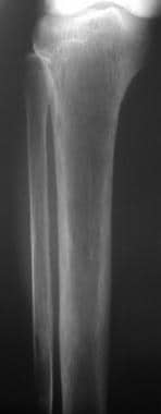 Radiograph of the proximal tibia and fibula. Diffu