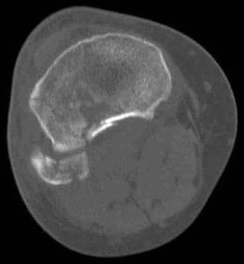 Tibial plateau fractures. Axial CT image of the sa