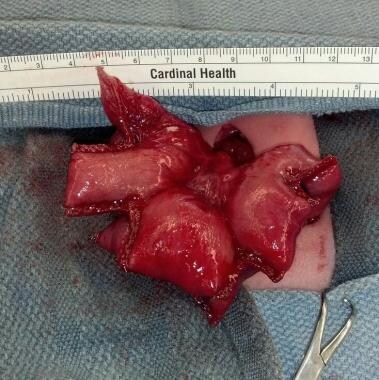 Intestinal obstruction in the newborn. STEP proced
