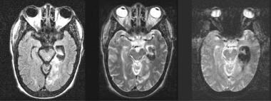 Intracranial hemorrhage. Fluid-attenuated inversio